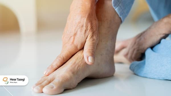 بیماری نقرس چیست و چه علائمی دارد